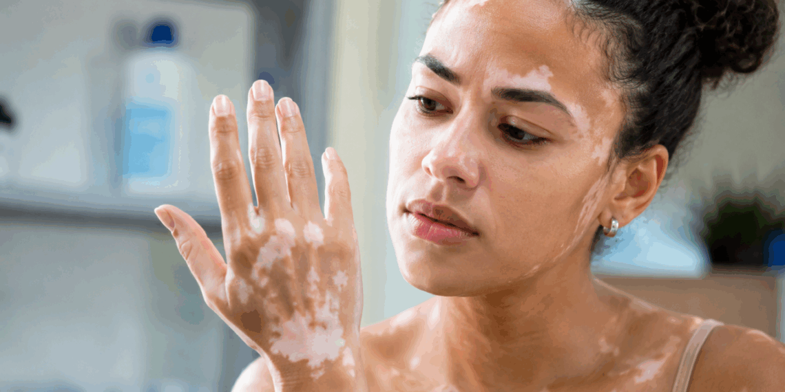 Vitiligo pode surgir após estresse? O que a ciência descobriu sobre as manchas brancas espalhadas pelo seu corpo