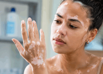 Vitiligo pode surgir após estresse? O que a ciência descobriu sobre as manchas brancas espalhadas pelo seu corpo