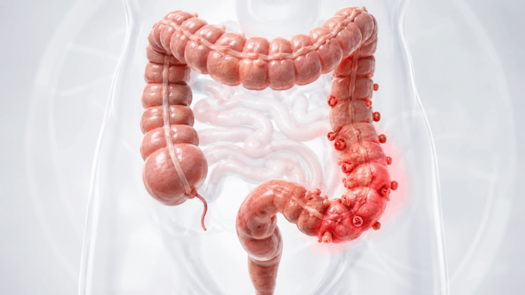 Dor do lado esquerdo da barriga pode esconder um problema intestinal pouco percebido
