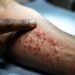 Esfregou a mancha e ela inchou na hora? Este sinal de pele pode indicar acúmulo anormal de células no corpo