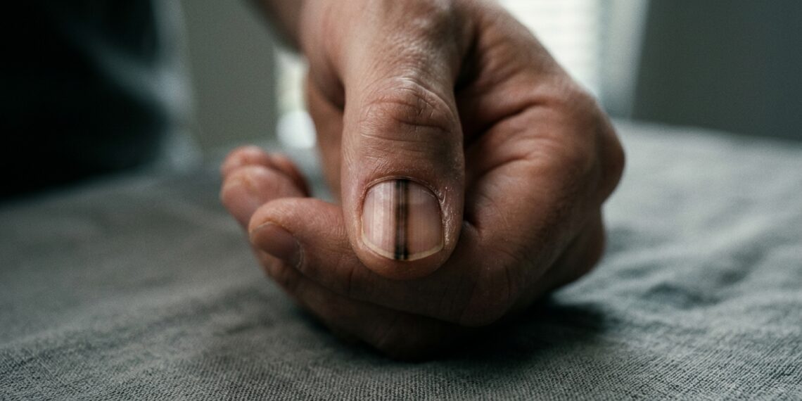 Os sinais de alerta nas unhas que exigem um dermatologista em até 2 semanas