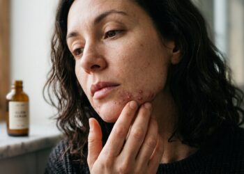 40% das mulheres têm acne hormonal após os 30 e a maioria está tratando do jeito errado
