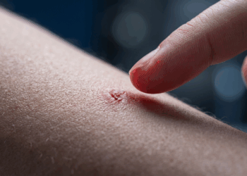 Dermatilomania e o impulso de cutucar: Como parar de arrancar casquinhas de feridas