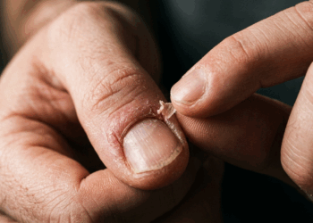 Por que temos a forte compulsão de arrancar pele ao redor das unhas? Entenda a ciência