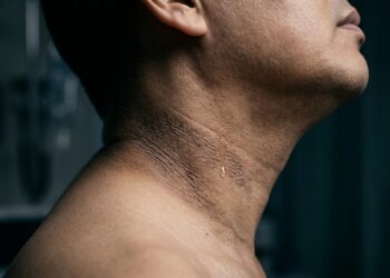 O sinal na pele que aparece antes do diabetes tipo 2 e que muitos confundem com "coisa de idade”