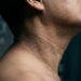 O sinal na pele que aparece antes do diabetes tipo 2 e que muitos confundem com "coisa de idade”