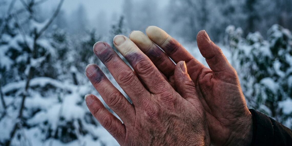 Mãos com dedos brancos e arroxeados devido a vasoespasmo durante exposição ao frio intenso.