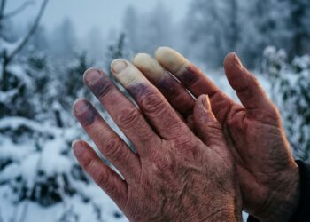 Mãos com dedos brancos e arroxeados devido a vasoespasmo durante exposição ao frio intenso.