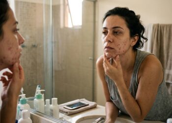 Mulher adulta com sinais de cansaço observa lesões de acne no queixo e na mandíbula diante do espelho.